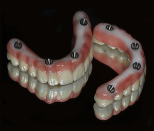 Full mouth implant