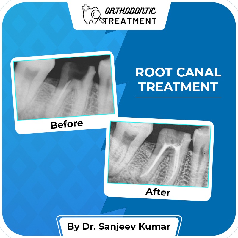 Root and Treatment